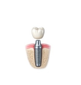 Single-Tooth Implant diagram