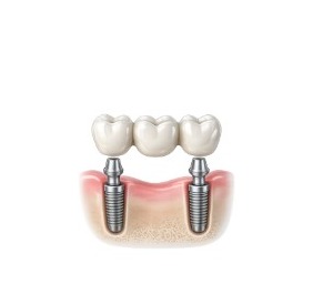 Implant Bridges diagram