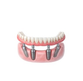 All-on-4 Dental Implants diagram