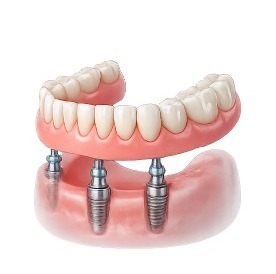 Implant-Supported Dentures diagram