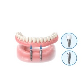 Mini Dental Implants diagram